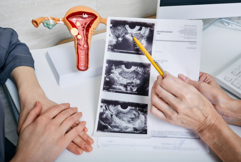 PCOS and IVF Treatment